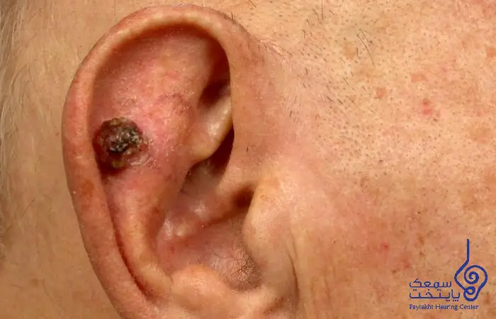 سرطان گوش